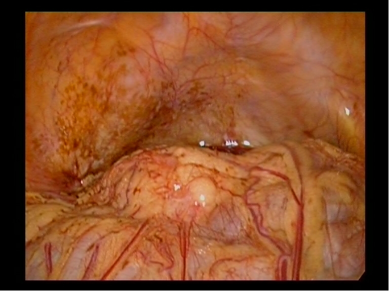 Endometriosis Anterior Pouch Youssif Endometriosis Anterior Pouch Youssif